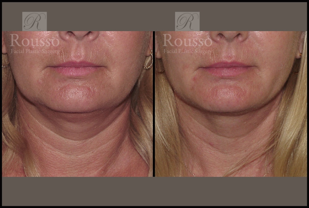 Acculift <span class=small>By Dr. Daniel Rousso</span> Before & After Gallery - Patient 2837802 - Image 4