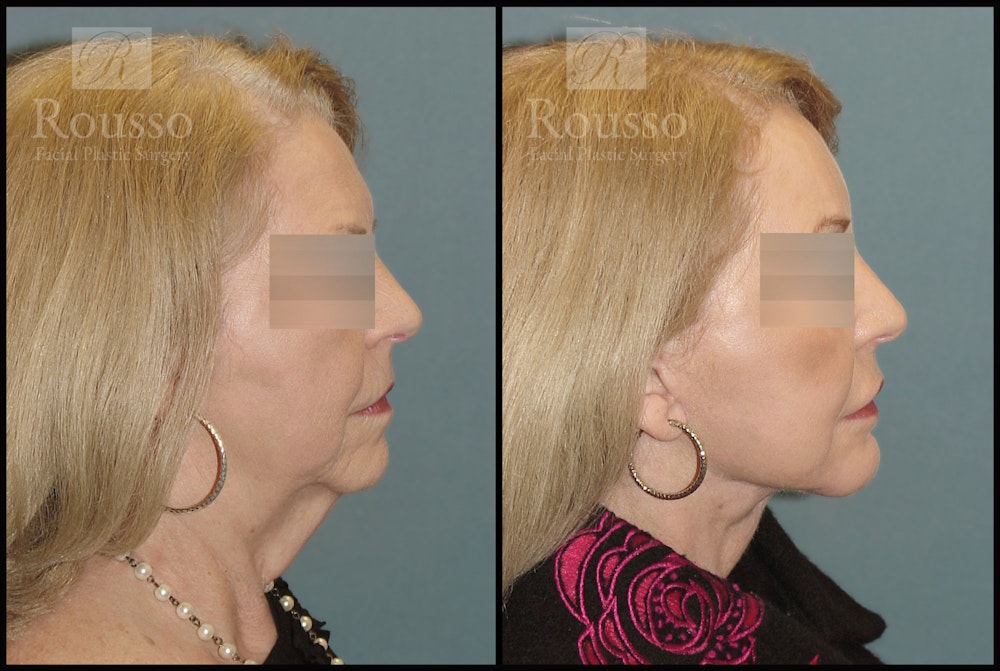 SculptLift™ <span class=small>By Dr. Daniel Rousso</span> Before & After Gallery - Patient 2838967 - Image 3
