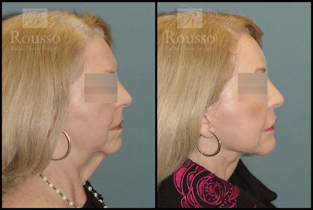 SculptLift™ Before & After Gallery - Patient 2838967 - Image 3