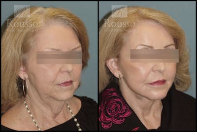 SculptLift™ <span class=small>By Dr. Daniel Rousso</span> Before & After Gallery - Patient 2838967 - Image 2