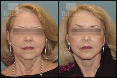 SculptLift™ <span class=small>By Dr. Daniel Rousso</span> Before & After Gallery - Patient 2838967 - Image 1