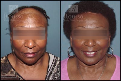 Hair Transplant Before & After Gallery - Patient 3201046 - Image 1