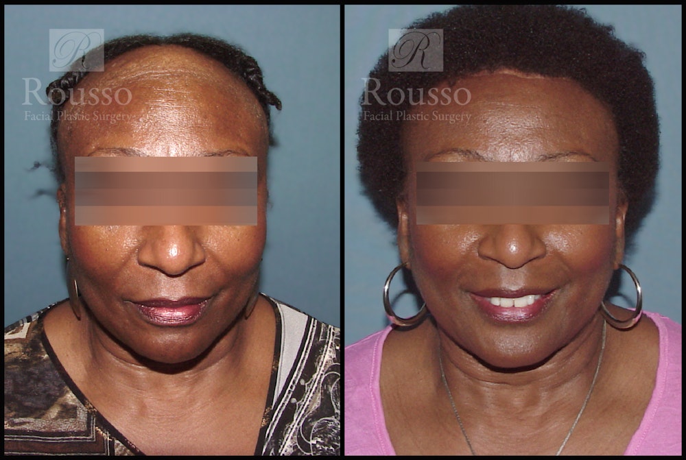 Before & After