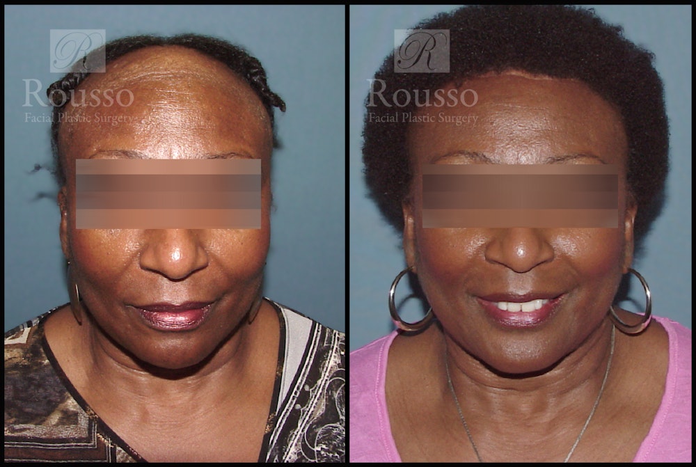 Hair Transplant Before & After Gallery - Patient 3201046 - Image 1