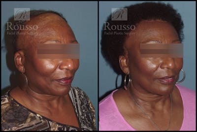 Hair Transplant Before & After Gallery - Patient 3201046 - Image 2