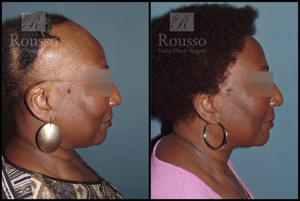 Hair Transplant Gallery - Patient 3201046 - Image 3