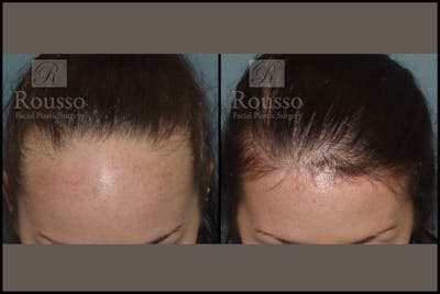 Hair Transplant Before & After Gallery - Patient 3201069 - Image 1