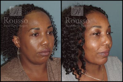 Hair Transplant Before & After Gallery - Patient 3201070 - Image 1