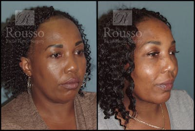 Hair Transplant Gallery - Patient 3201070 - Image 1