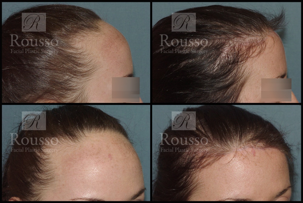 Hair Transplant Before & After Gallery - Patient 3201069 - Image 2