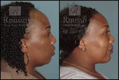 Hair Transplant Before & After Gallery - Patient 3201070 - Image 2