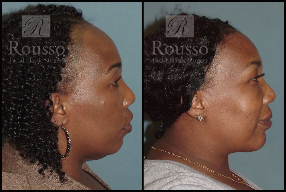 Hair Transplant Before & After Gallery - Patient 3201070 - Image 2
