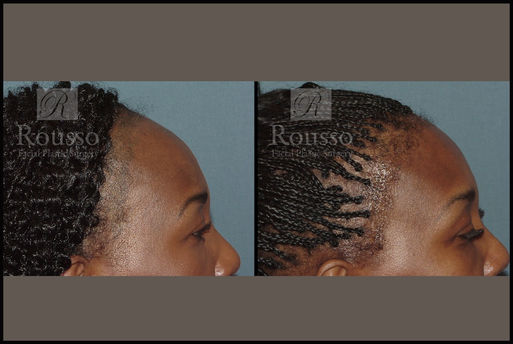 Hair Transplant Gallery - Patient 3201070 - Image 3
