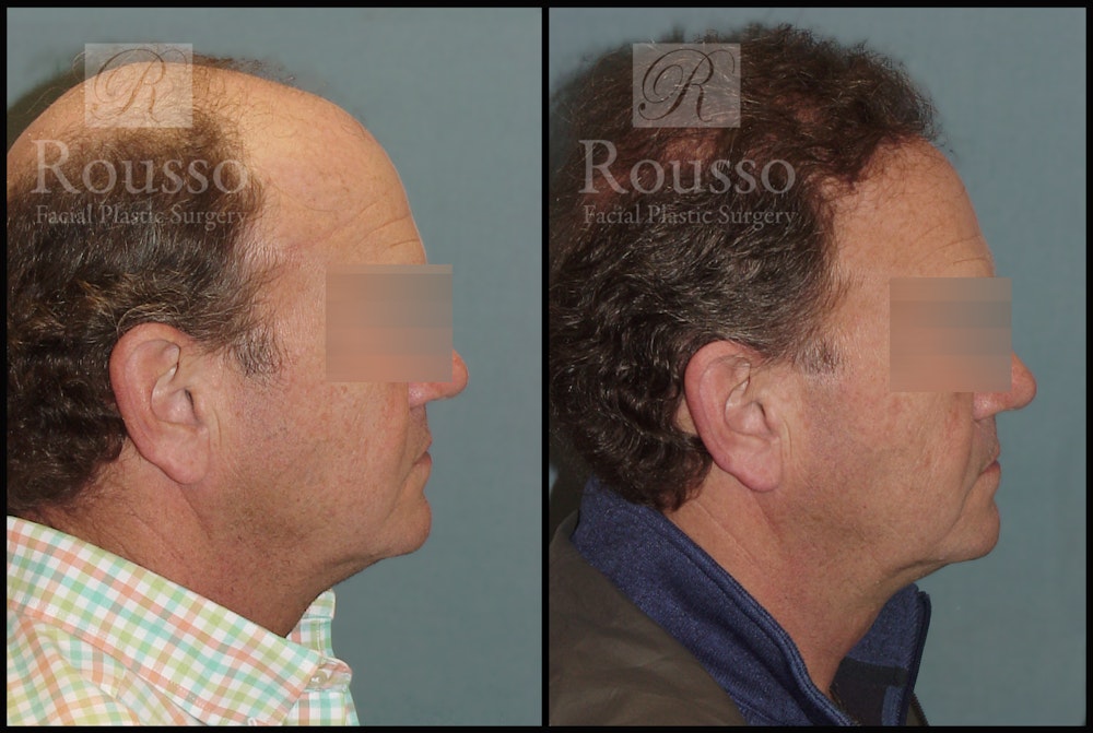 Hair Transplant Before & After Gallery - Patient 2574218 - Image 3