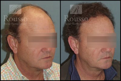 Hair Transplant Before & After Gallery - Patient 2574218 - Image 2