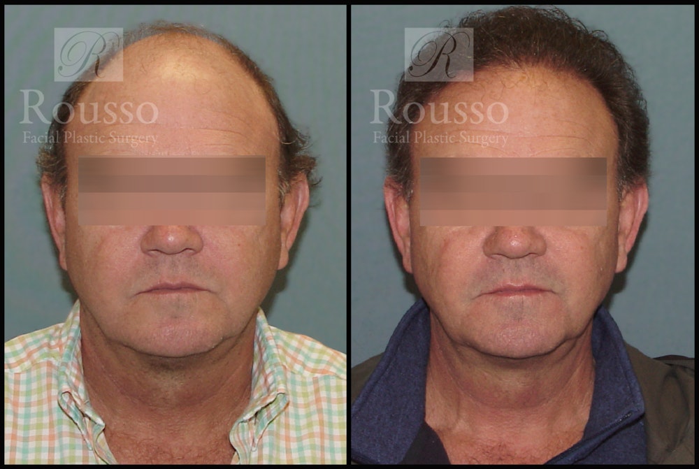 Hair Transplant Before & After Gallery - Patient 2574218 - Image 1