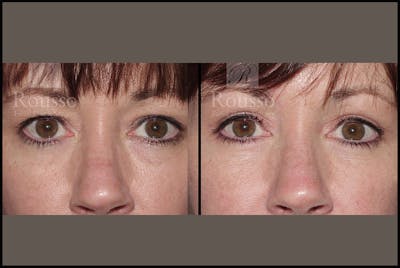 Blepharoplasty <span class=small>By Dr. Daniel Rousso</span> Before & After Gallery - Patient 2205363 - Image 1