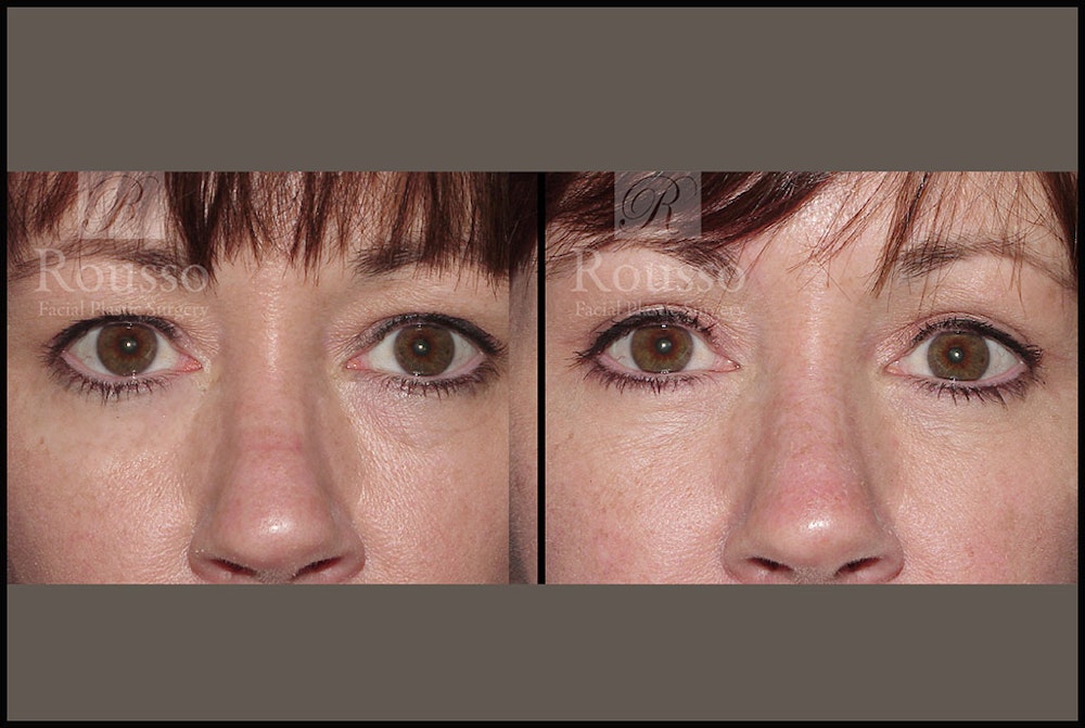 Blepharoplasty Before & After Gallery - Patient 2205363 - Image 1