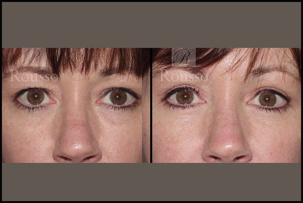 Blepharoplasty <span class=small>By Dr. Daniel Rousso</span> Before & After Gallery - Patient 2205363 - Image 1