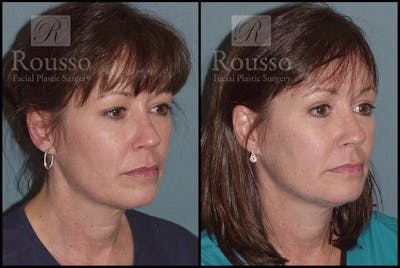 Blepharoplasty <span class=small>By Dr. Daniel Rousso</span> Before & After Gallery - Patient 2205363 - Image 2