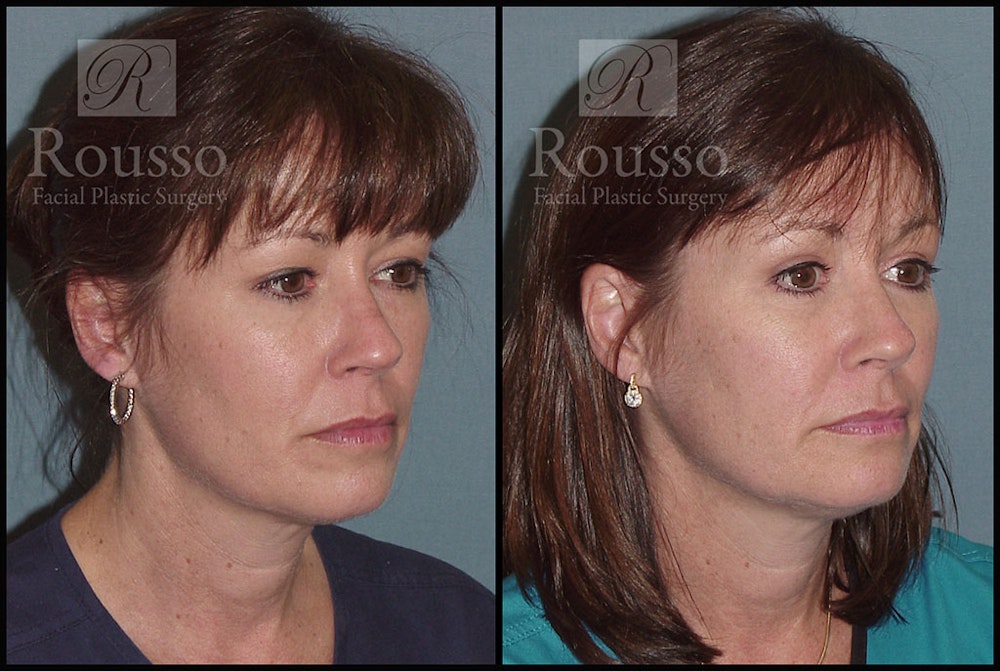 Blepharoplasty <span class=small>By Dr. Daniel Rousso</span> Before & After Gallery - Patient 2205363 - Image 2