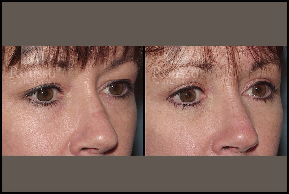 Blepharoplasty Before & After Gallery - Patient 2205363 - Image 3