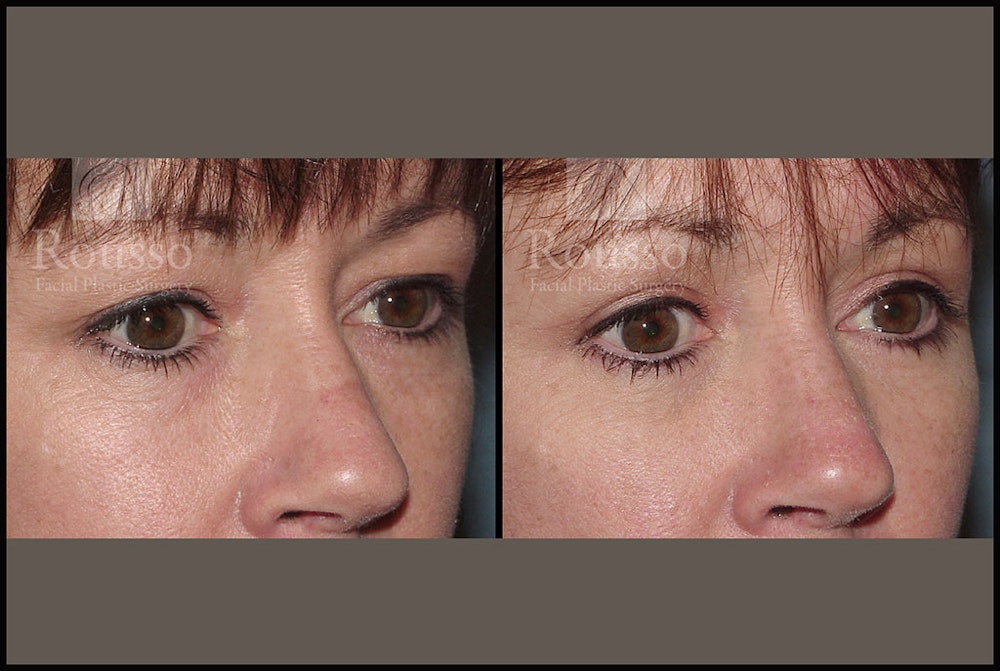 Blepharoplasty <span class=small>By Dr. Daniel Rousso</span> Before & After Gallery - Patient 2205363 - Image 3