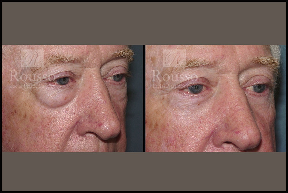 Blepharoplasty Before & After Gallery - Patient 2029499 - Image 3