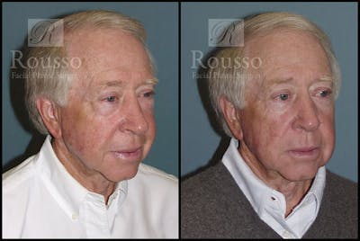 Blepharoplasty <span class=small>By Dr. Daniel Rousso</span> Before & After Gallery - Patient 2029499 - Image 4