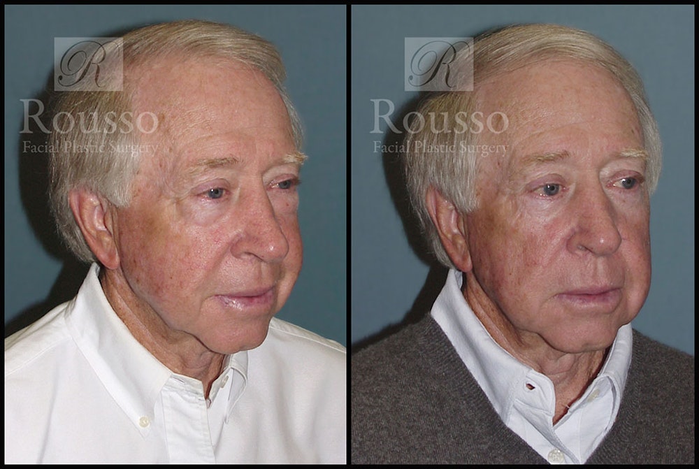 Blepharoplasty <span class=small>By Dr. Daniel Rousso</span> Before & After Gallery - Patient 2029499 - Image 4