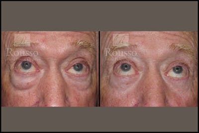 Blepharoplasty <span class=small>By Dr. Daniel Rousso</span> Before & After Gallery - Patient 2029499 - Image 2