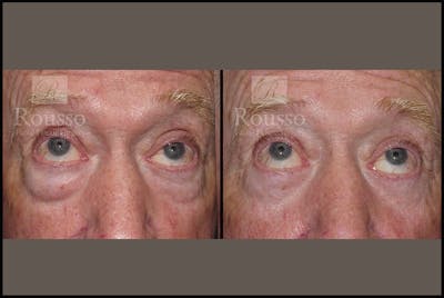 Blepharoplasty Before & After Gallery - Patient 2029499 - Image 2