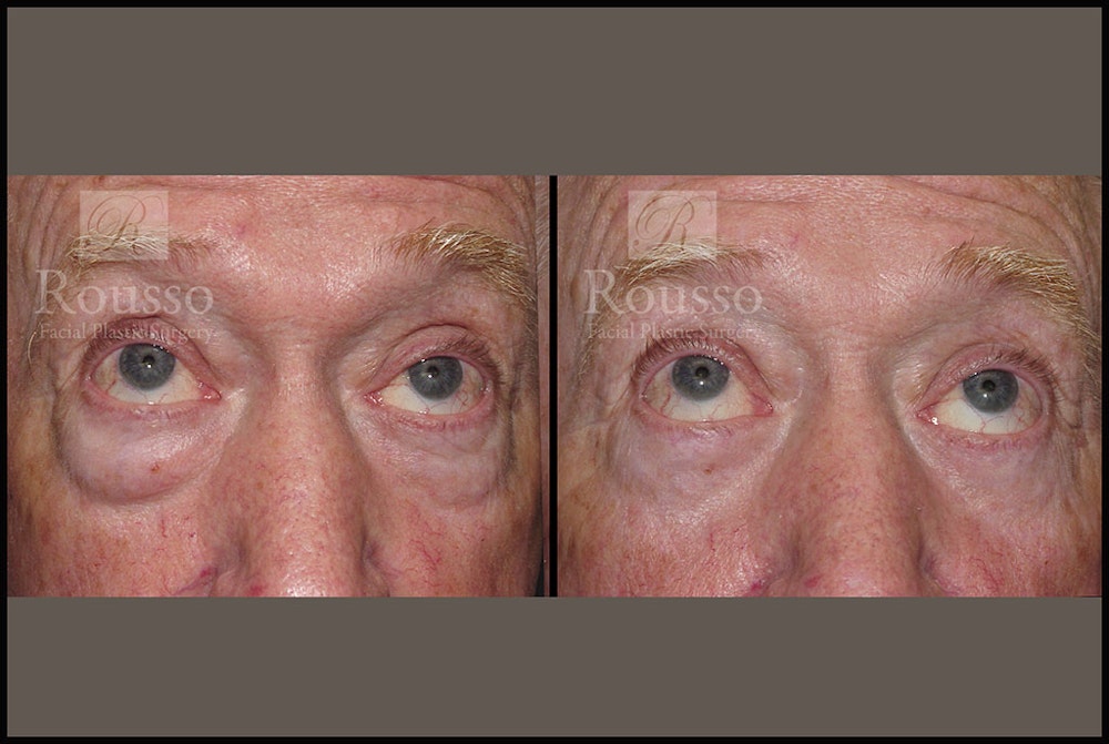 Blepharoplasty <span class=small>By Dr. Daniel Rousso</span> Before & After Gallery - Patient 2029499 - Image 2