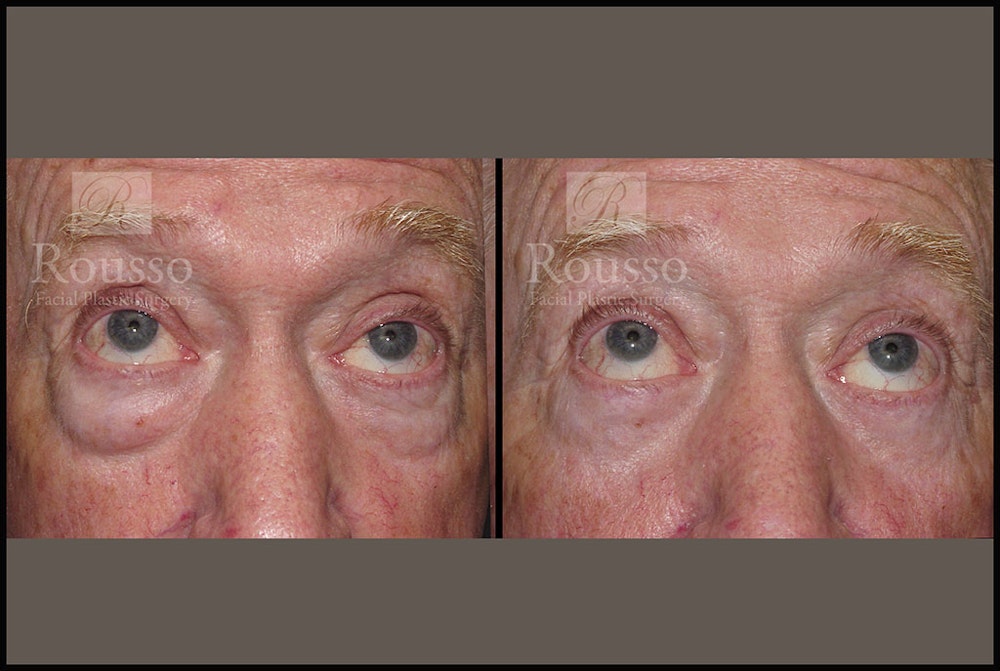 Blepharoplasty Before & After Gallery - Patient 2029499 - Image 2