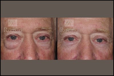 Blepharoplasty <span class=small>By Dr. Daniel Rousso</span> Before & After Gallery - Patient 2029499 - Image 1