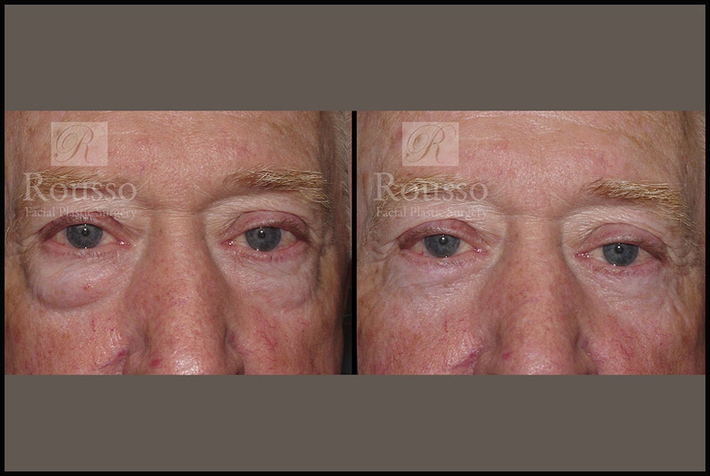 Blepharoplasty Before & After Gallery - Patient 2029499 - Image 1