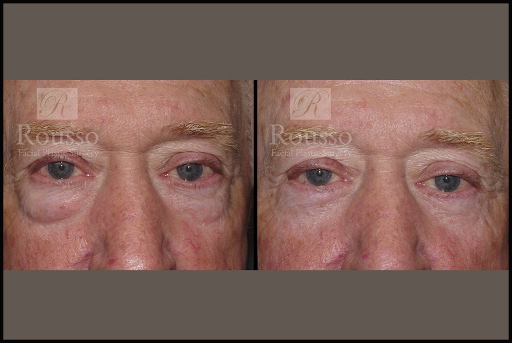 Blepharoplasty <span class=small>By Dr. Daniel Rousso</span> Before & After Gallery - Patient 2029499 - Image 1