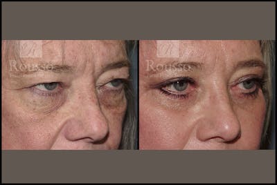 Blepharoplasty <span class=small>By Dr. Daniel Rousso</span> Before & After Gallery - Patient 3256890 - Image 1
