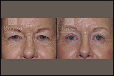 Blepharoplasty <span class=small>By Dr. Daniel Rousso</span> Before & After Gallery - Patient 3256891 - Image 1