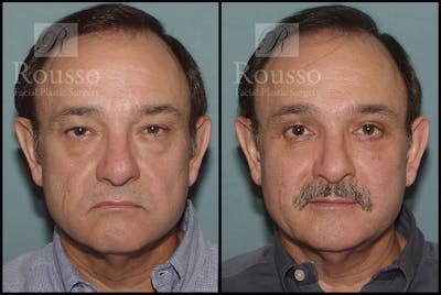 Blepharoplasty <span class=small>By Dr. Daniel Rousso</span> Before & After Gallery - Patient 3256892 - Image 1