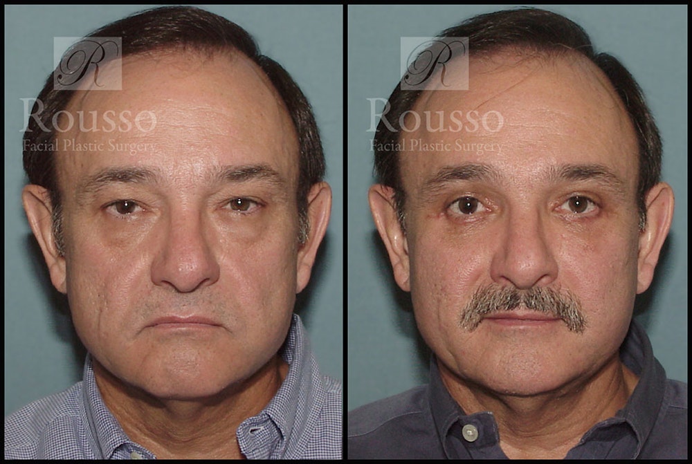 Blepharoplasty <span class=small>By Dr. Daniel Rousso</span> Before & After Gallery - Patient 3256892 - Image 1