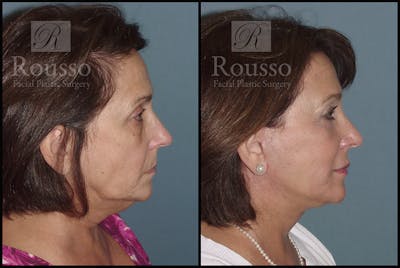 Facelift Before & After Gallery - Patient 3261699 - Image 2