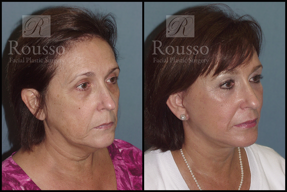 Facelift Before & After Gallery - Patient 3261699 - Image 1