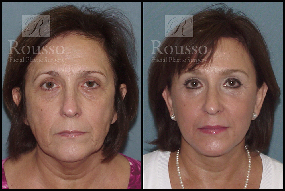 Facelift Before & After Gallery - Patient 3261699 - Image 3