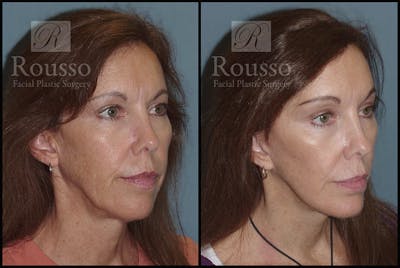 MiniLift <span class=small>By Dr. Daniel Rousso</span> Before & After Gallery - Patient 3262152 - Image 2