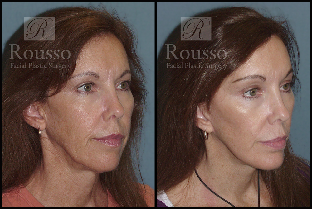 MiniLift <span class=small>By Dr. Daniel Rousso</span> Before & After Gallery - Patient 3262152 - Image 2