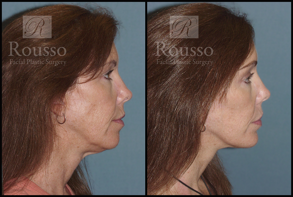 MiniLift <span class=small>By Dr. Daniel Rousso</span> Before & After Gallery - Patient 3262152 - Image 3