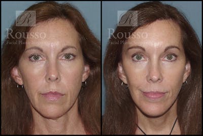 MiniLift <span class=small>By Dr. Daniel Rousso</span> Before & After Gallery - Patient 3262152 - Image 1
