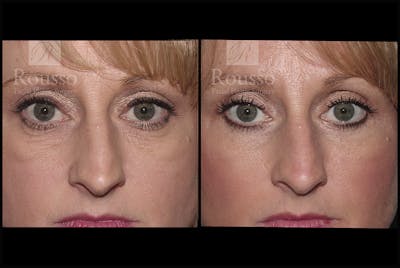 Blepharoplasty Before & After Gallery - Patient 3262170 - Image 1