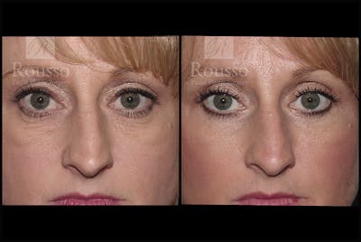 Blepharoplasty <span class=small>By Dr. Daniel Rousso</span> Before & After Gallery - Patient 3262170 - Image 1